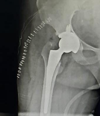 Total Hip Replacement Post Operative
