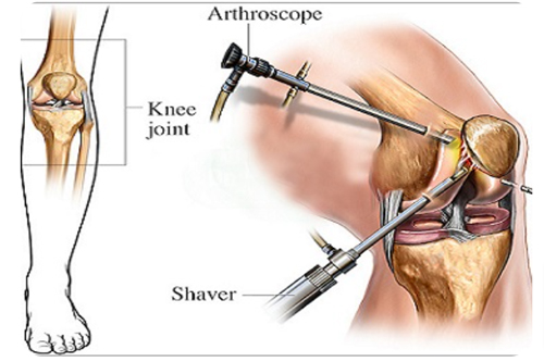 Arthroscopic Surgery knee operation explain