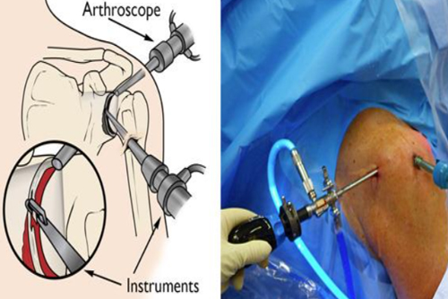 Shoulder Arthroscopy Explain in diagram and practical in operation Theater