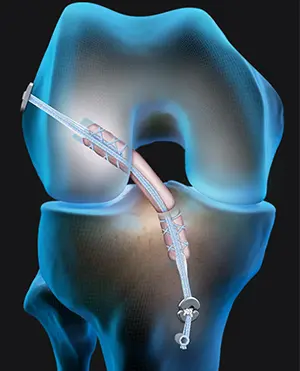 ACL Reconstruction In Nagpur