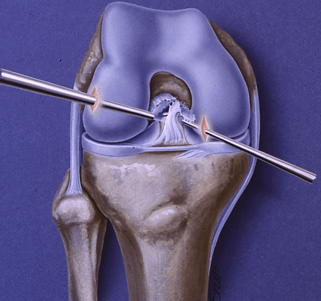 ACL Surgery In Balaghat