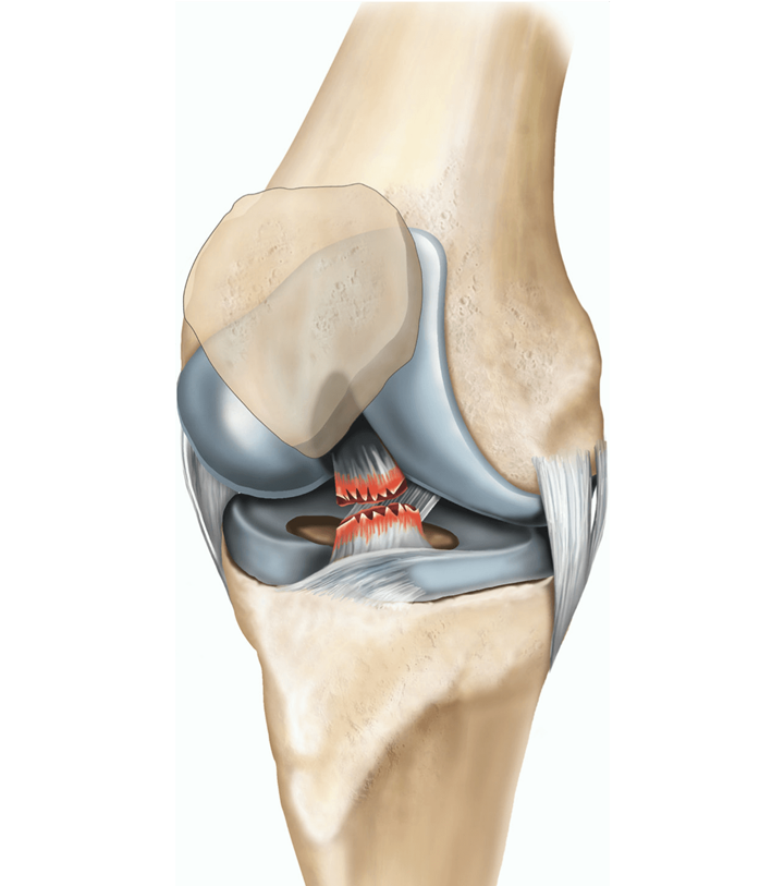 ACL Surgery In Chhindwara