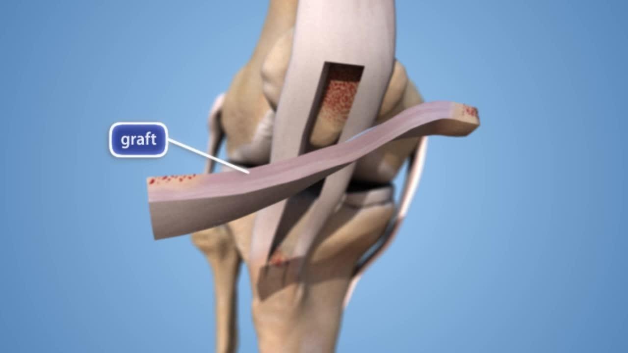 ACL Surgery In Gondia