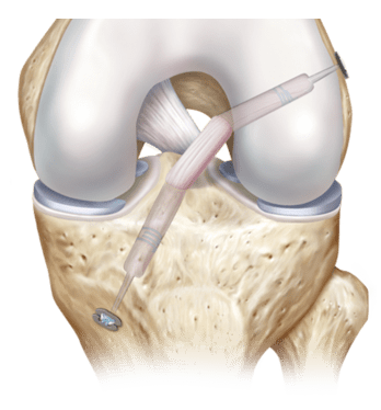 ACL Surgery In Narsinghpur