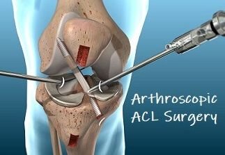 ACL Surgery In Sagar