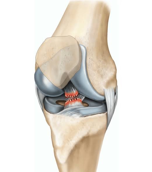 ACL Surgery In Satna