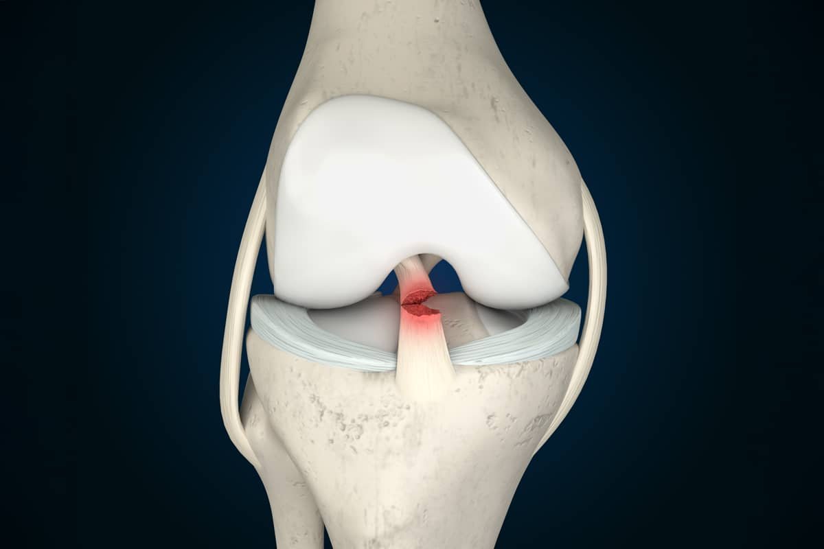 ACL Surgery In Yavatmal