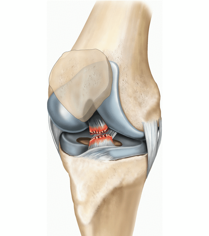 ACL Surgery In katni