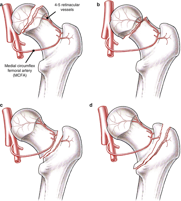 AVN Injury In Nagpur