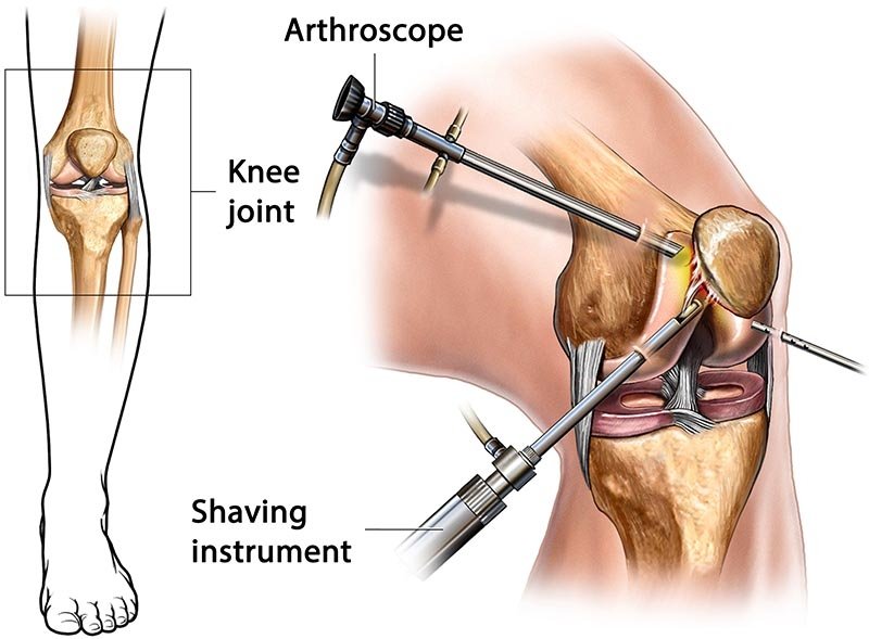 Arthroscopic Surgery In Bhandara