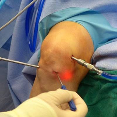 Arthroscopic Surgery In Gadchiroli