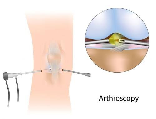 Arthroscopic Surgery In Narsinghpur