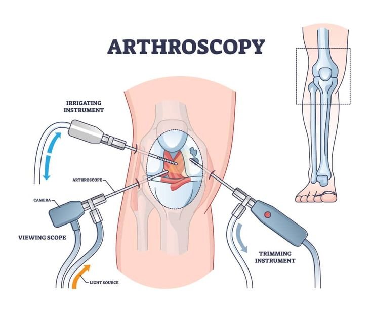 Arthroscopic Surgery In Shadol