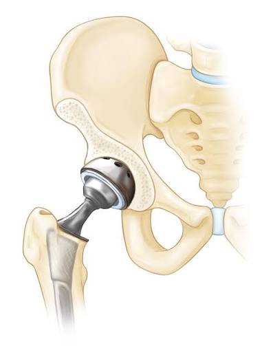 Avascular Necrosis Treatment In Nagpur