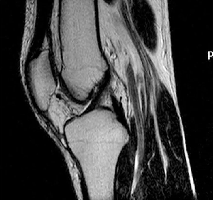 Best ACL Doctor In Amravati