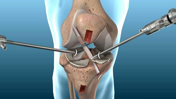 Best ACL Doctor In Betul