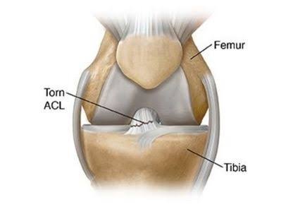 Best ACL Doctor In Katni