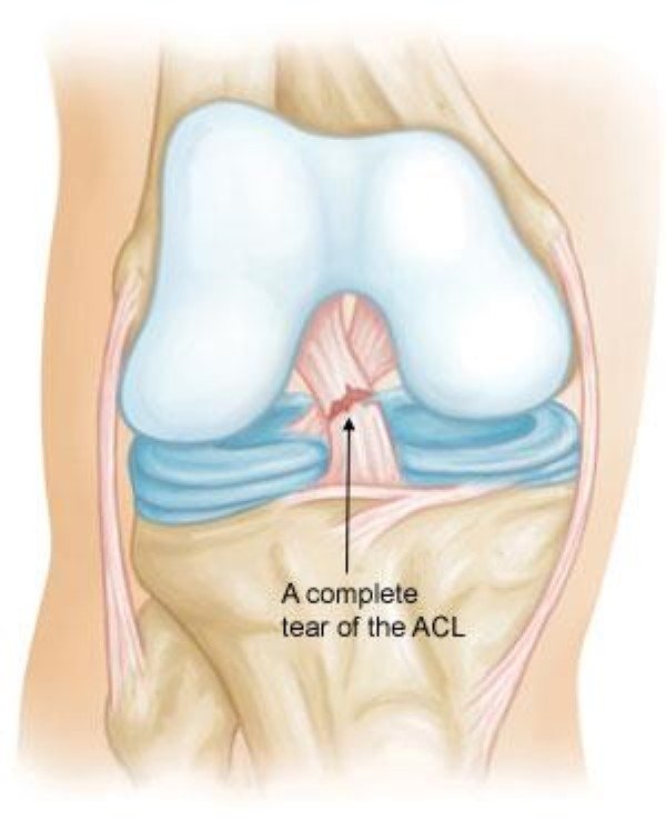 Best ACL Doctor In Seoni