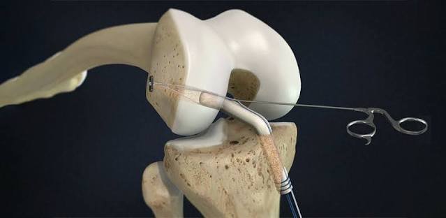 Best ACL Doctor In Wardha