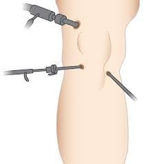 Best Arthroscopy Hospital In Nagpur