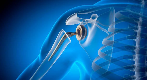 Best Joint Replacement In Nagpur
