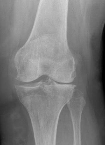 Best Knee Surgeon In Chhindwara