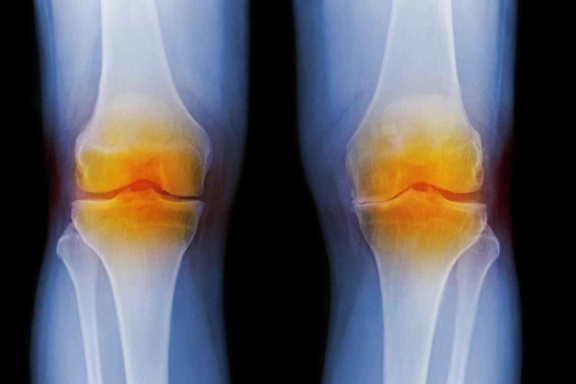 Best Knee Surgeon In Rewa