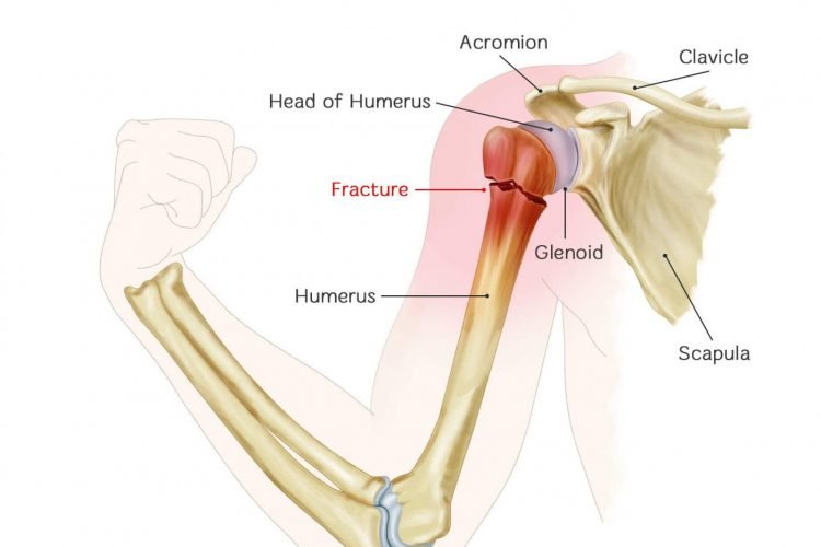 Best Shoulder Fracture In Nagpur