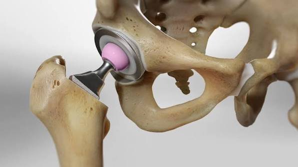 Hip Replacement Surgery In Nagpur