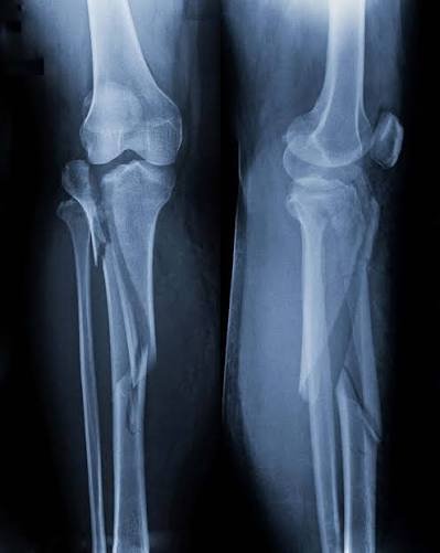 Knee Fracture In Nagpur