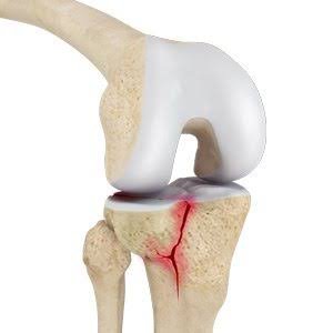Knee Fracture Surgery In Nagpur