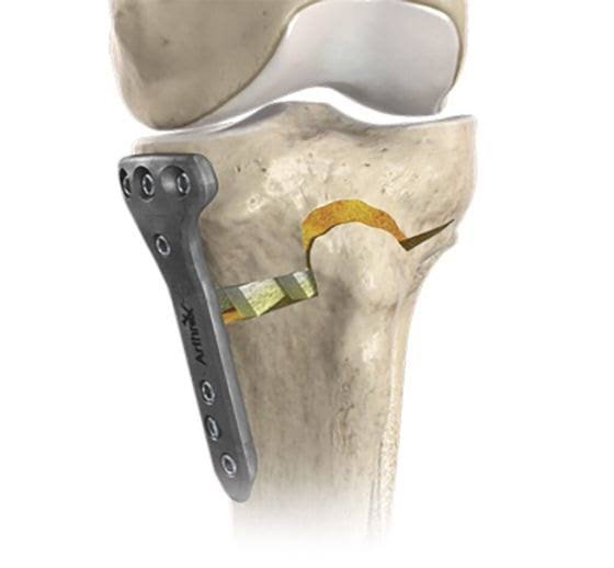 Knee Joint Preservation Surgery In Nagpur
