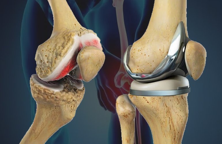 Knee Replacement Surgery In Amravati