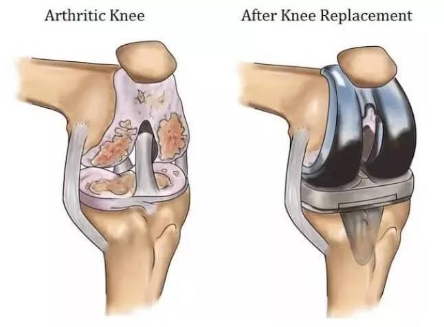 Knee Replacement Surgery In Balaghat
