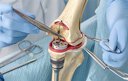 Knee Replacement Surgery In Betul