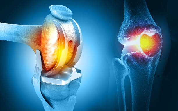 Knee Replacement Surgery In Gadchiroli