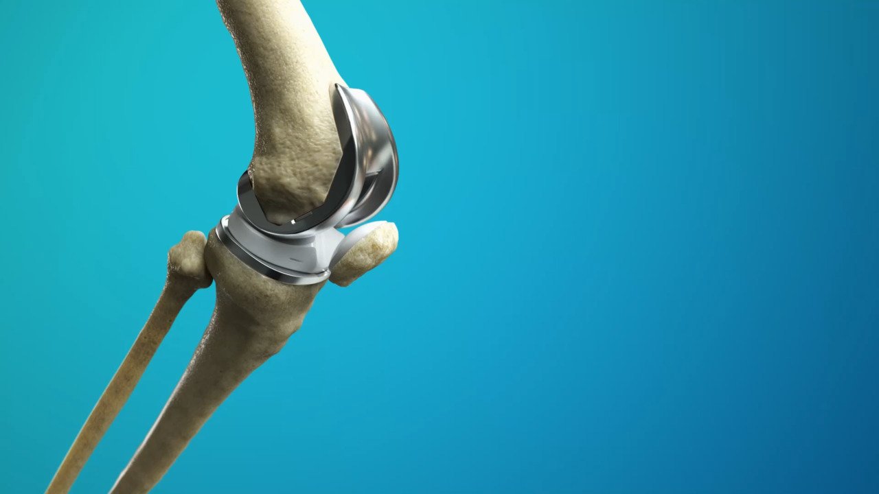 Knee Replacement Surgery In Gondia