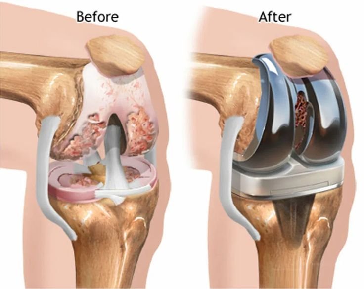 Knee Replacement Surgery In Itarsi