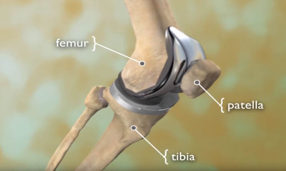 Knee Replacement Surgery In Jabalpur