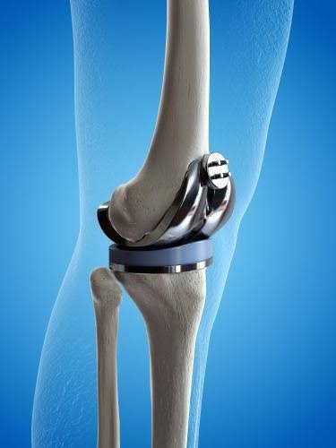 Knee Replacement Surgery In Nagpur