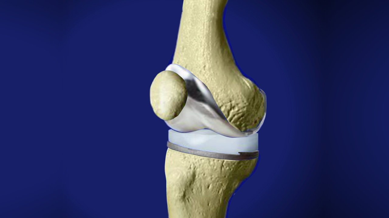 Knee Replacement Surgery In Narsinghpur