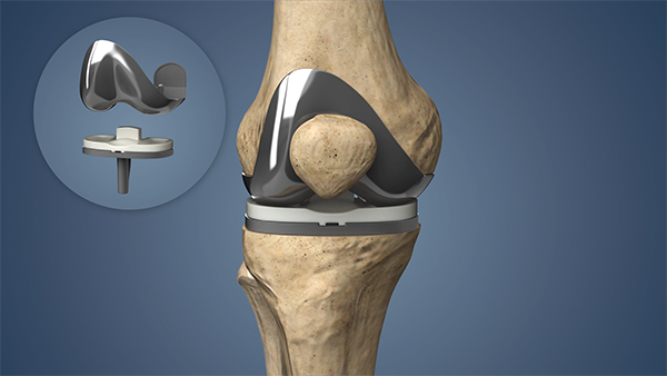 Knee Replacement Surgery In Wardha