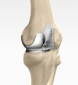 Knee Replacement Surgery In katni