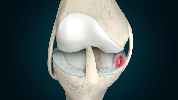 Meniscus Tear In Nagpur