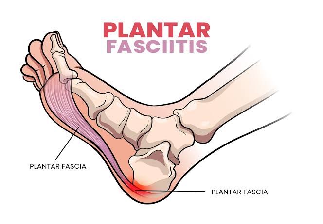 Plantar Fasciitis In Nagpur