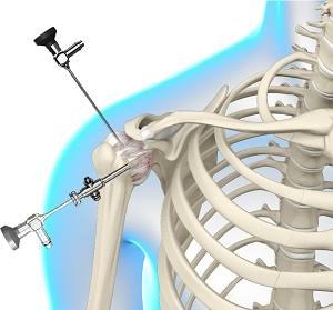 Shoulder Arthroscopy In Amravati
