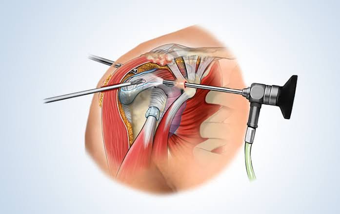Shoulder Arthroscopy In Chhindwara