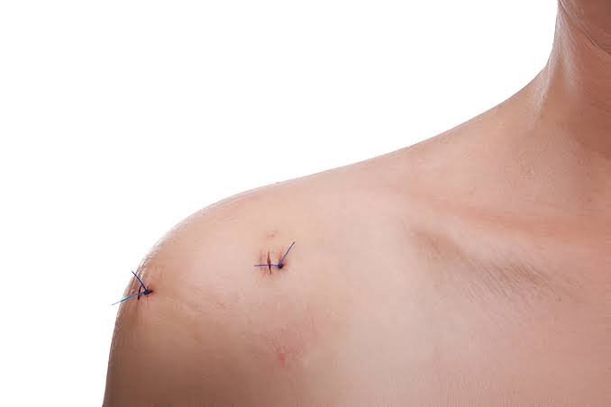 Shoulder Arthroscopy In Gondia