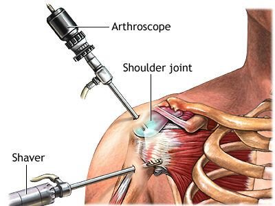 Shoulder Arthroscopy In Itarsi