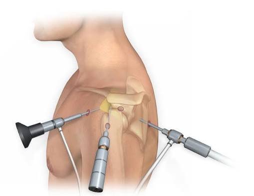 Shoulder Arthroscopy In Jabalpur